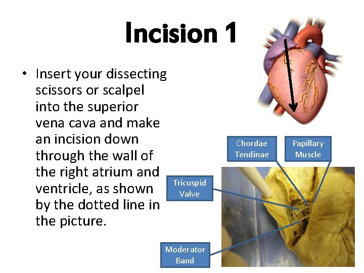 Incision 1 • Insert your dissecting scissors or scalpel into the superior vena cava