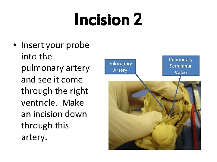 Incision 2 • Insert your probe into the pulmonary artery and see it come