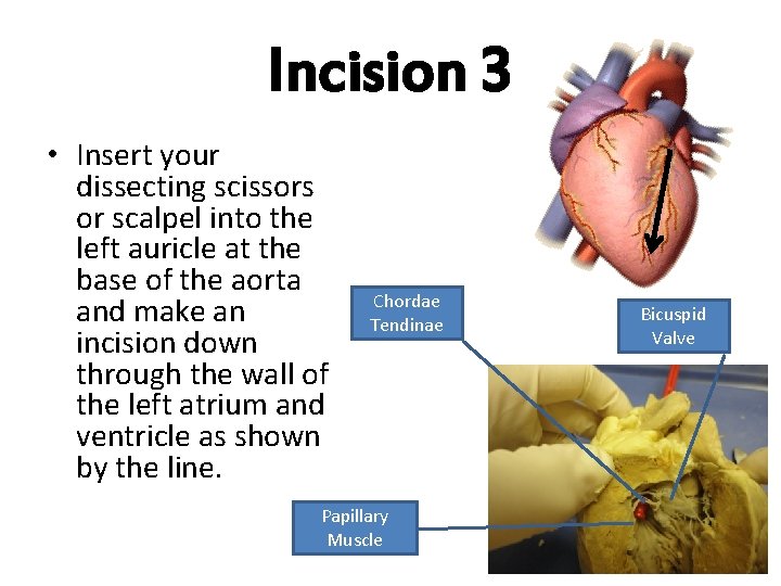 Incision 3 • Insert your dissecting scissors or scalpel into the left auricle at