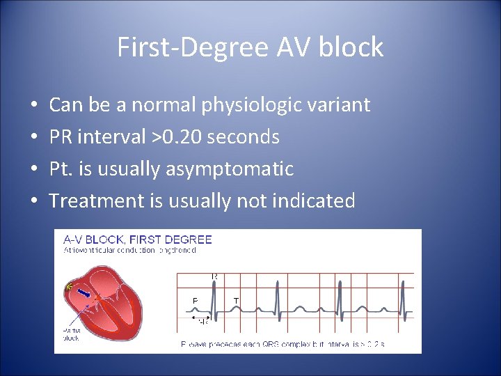 First-Degree AV block • • Can be a normal physiologic variant PR interval >0.