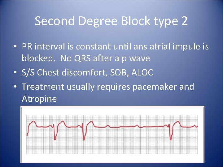 Second Degree Block type 2 • PR interval is constant until ans atrial impule