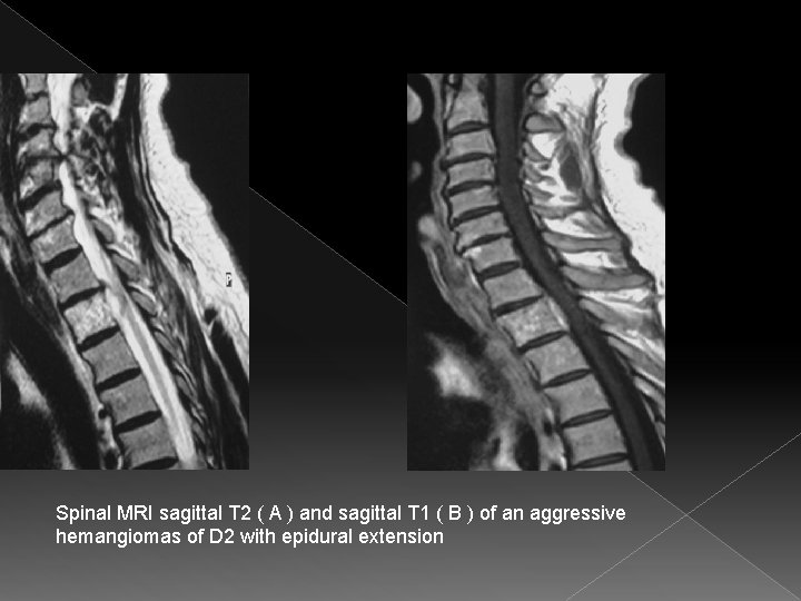 Spinal MRI sagittal T 2 ( A ) and sagittal T 1 ( B