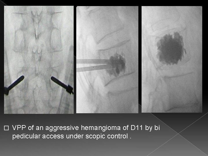 � VPP of an aggressive hemangioma of D 11 by bi pedicular access under