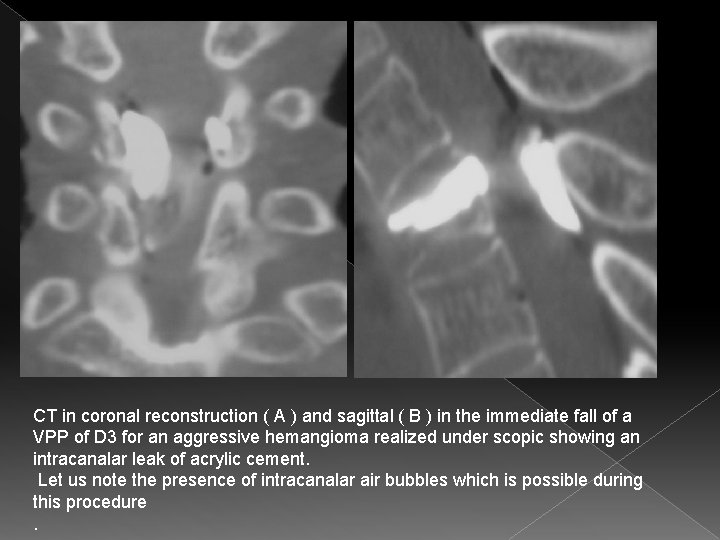 Discussion CT in coronal reconstruction ( A ) and sagittal ( B ) in