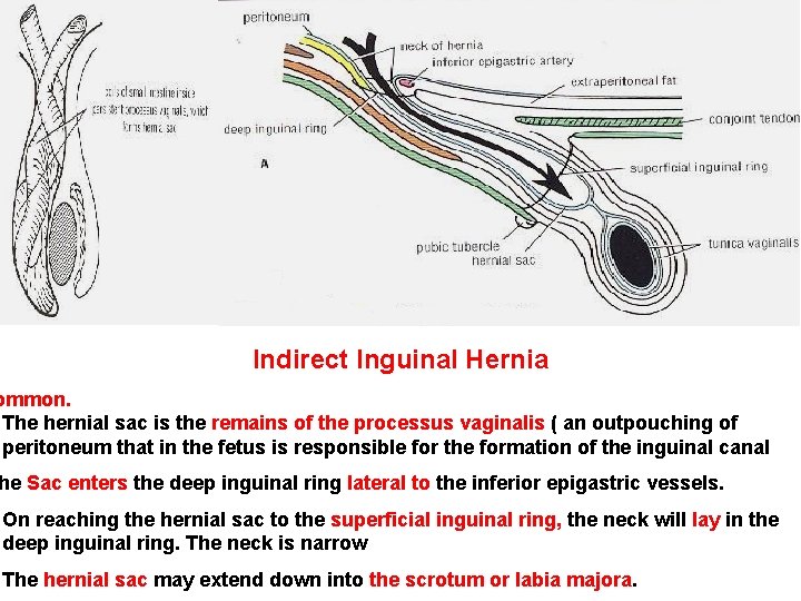 Indirect Inguinal Hernia ommon. The hernial sac is the remains of the processus vaginalis