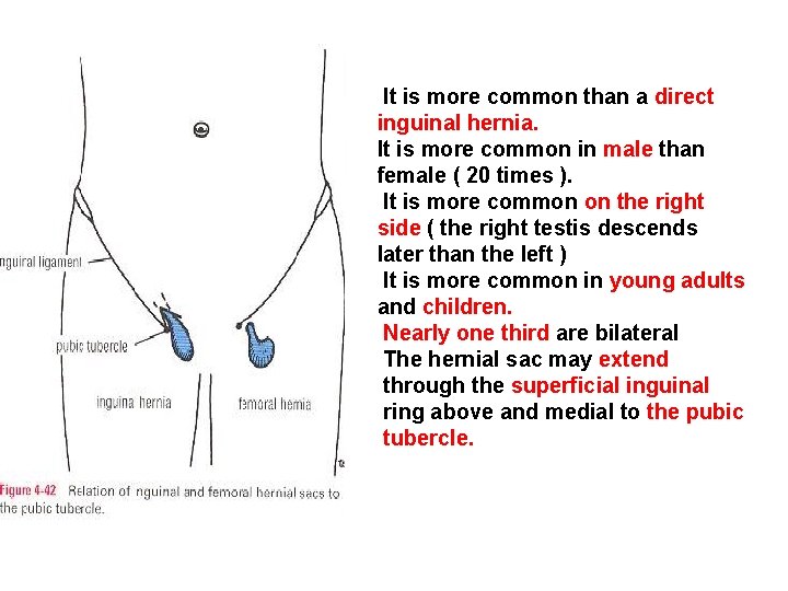 It is more common than a direct inguinal hernia. It is more common in