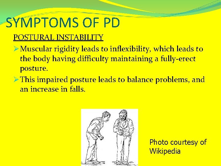 SYMPTOMS OF PD POSTURAL INSTABILITY Ø Muscular rigidity leads to inflexibility, which leads to