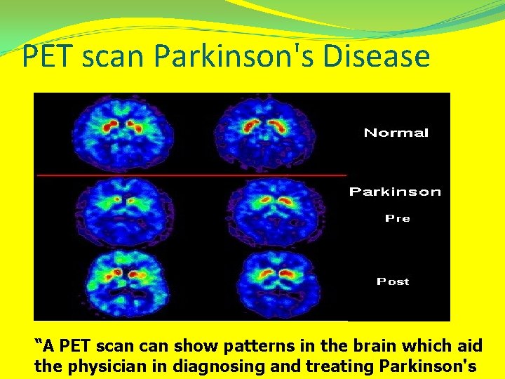 PET scan Parkinson's Disease “A PET scan show patterns in the brain which aid