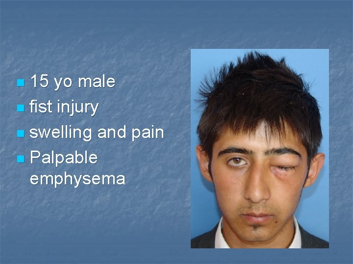 15 yo male n fist injury n swelling and pain n Palpable emphysema n