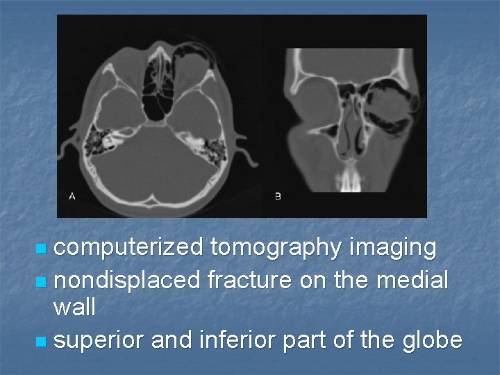 computerized tomography imaging n nondisplaced fracture on the medial wall n superior and inferior