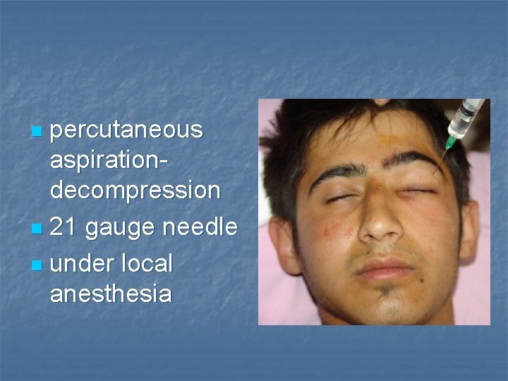 percutaneous aspirationdecompression n 21 gauge needle n under local anesthesia n 