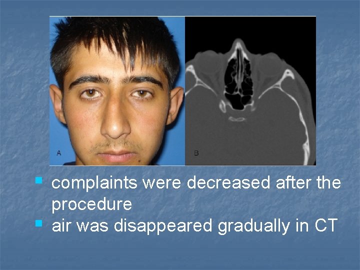 § complaints were decreased after the § procedure air was disappeared gradually in CT