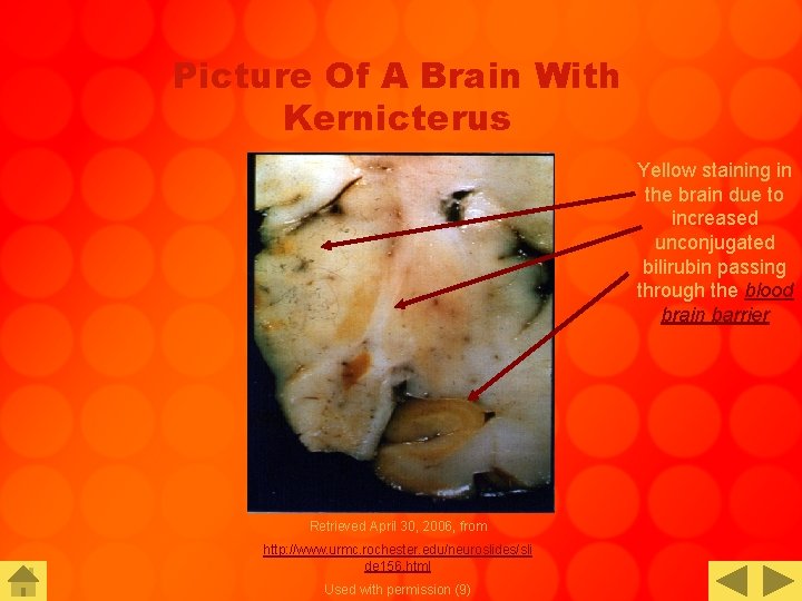 Picture Of A Brain With Kernicterus Yellow staining in the brain due to increased