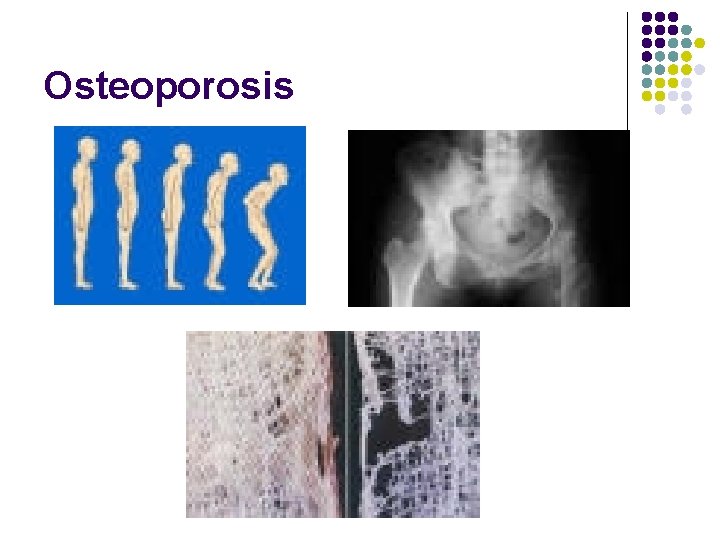 Osteoporosis 