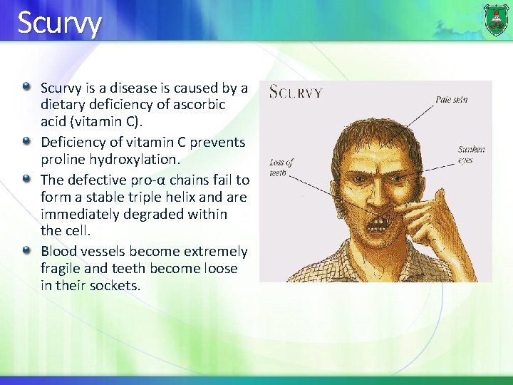 Scurvy is a disease is caused by a dietary deficiency of ascorbic acid (vitamin