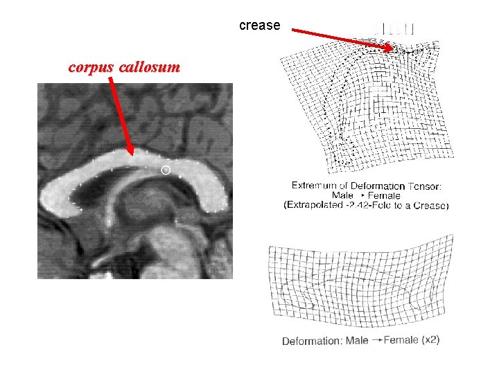 crease corpus callosum splenium 