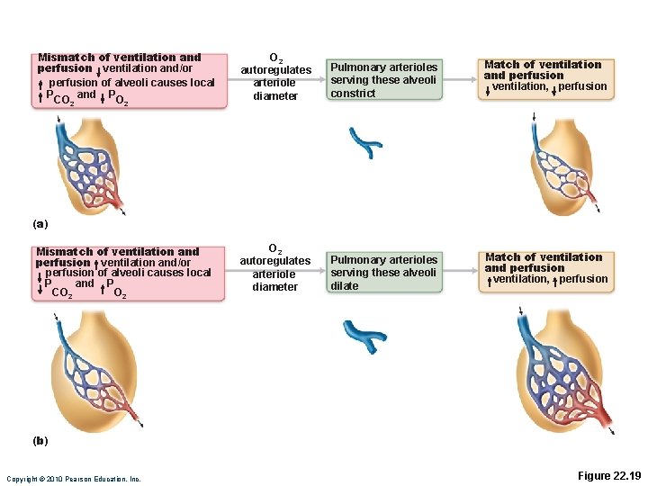 Mismatch of ventilation and perfusion ventilation and/or perfusion of alveoli causes local P and