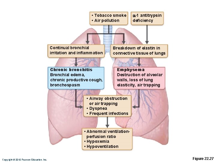  • Tobacco smoke • Air pollution a-1 antitrypsin deficiency Continual bronchial irritation and