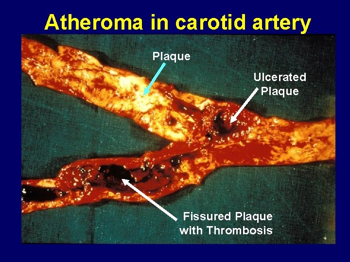 Atheroma in carotid artery Plaque Ulcerated Plaque Fissured Plaque with Thrombosis 