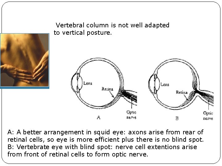 Vertebral column is not well adapted to vertical posture. A: A better arrangement in