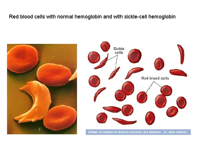 Red blood cells with normal hemoglobin and with sickle-cell hemoglobin 
