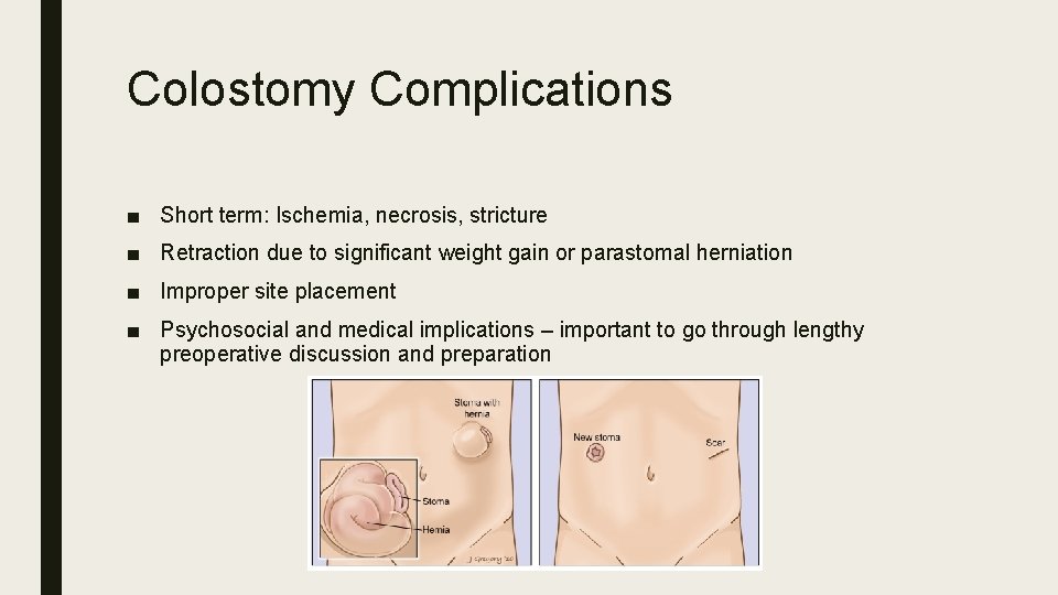 Colostomy Complications ■ Short term: Ischemia, necrosis, stricture ■ Retraction due to significant weight