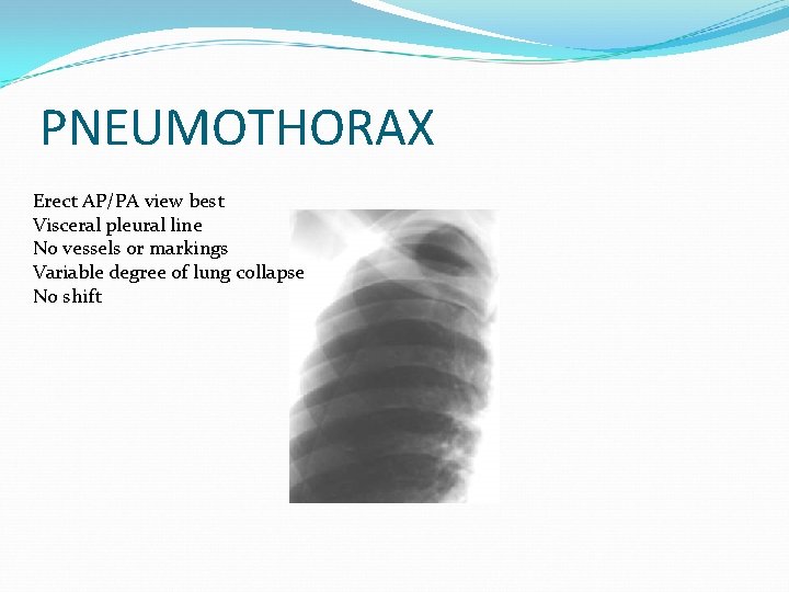 PNEUMOTHORAX Erect AP/PA view best Visceral pleural line No vessels or markings Variable degree