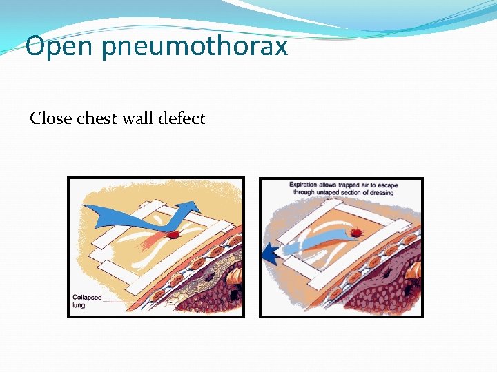 Open pneumothorax Close chest wall defect 