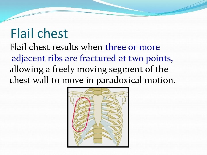 Flail chest results when three or more adjacent ribs are fractured at two points,