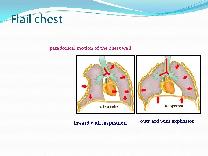 Flail chest paradoxical motion of the chest wall inward with inspiration outward with expiration