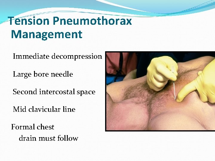 Tension Pneumothorax Management Immediate decompression Large bore needle Second intercostal space Mid clavicular line