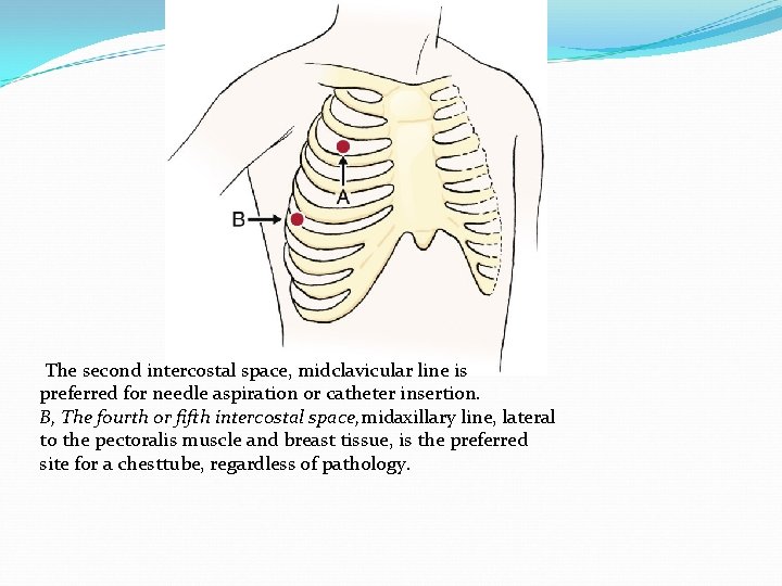 The second intercostal space, midclavicular line is preferred for needle aspiration or catheter insertion.