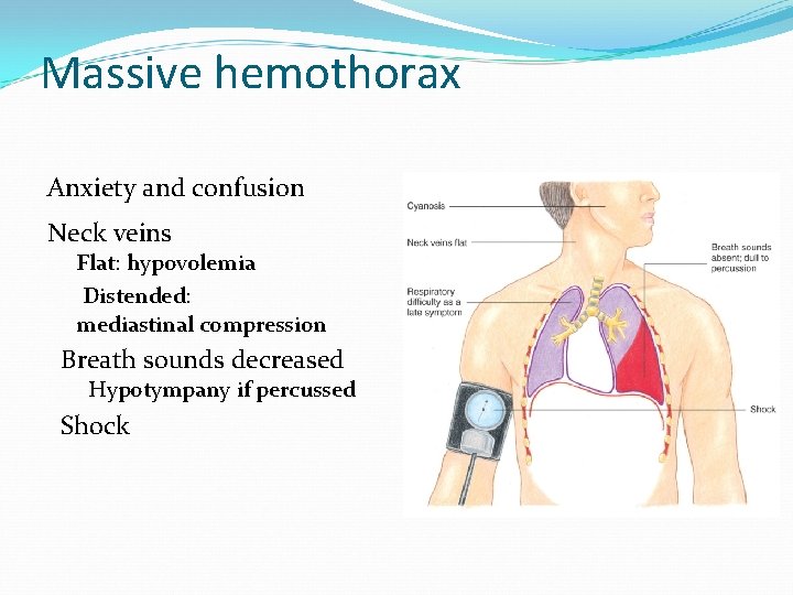 Massive hemothorax Anxiety and confusion Neck veins Flat: hypovolemia Distended: mediastinal compression Breath sounds