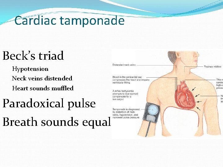 Cardiac tamponade Beck’s triad Hypotension Neck veins distended Heart sounds muffled Paradoxical pulse Breath