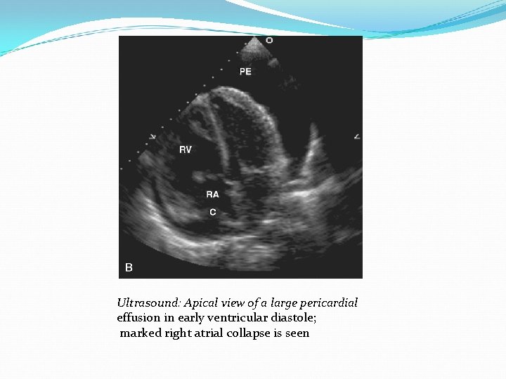 Ultrasound: Apical view of a large pericardial effusion in early ventricular diastole; marked right