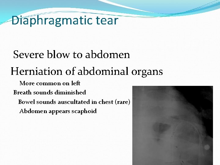 Diaphragmatic tear Severe blow to abdomen Herniation of abdominal organs More common on left