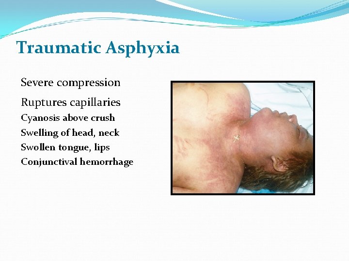 Traumatic Asphyxia Severe compression Ruptures capillaries Cyanosis above crush Swelling of head, neck Swollen