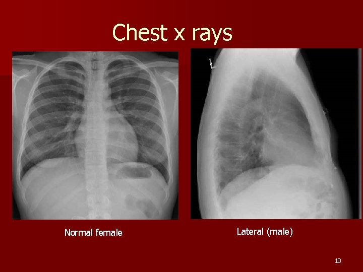 Chest x rays Normal female Lateral (male) 10 