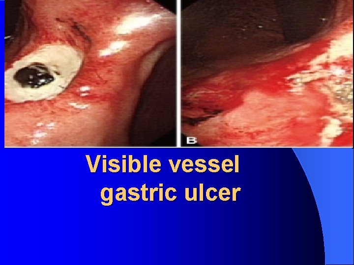 Visible vessel gastric ulcer 