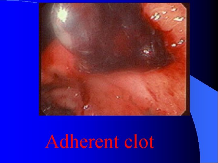 Adherent clot 