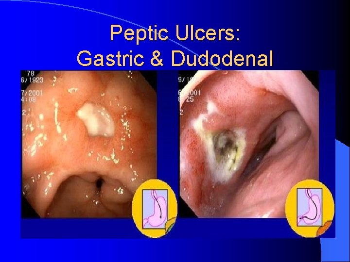 Peptic Ulcers: Gastric & Dudodenal 