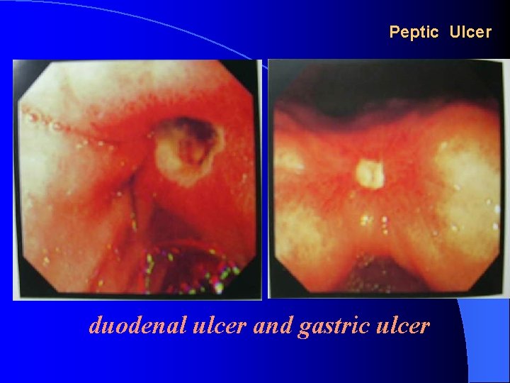 Peptic Ulcer duodenal ulcer and gastric ulcer 