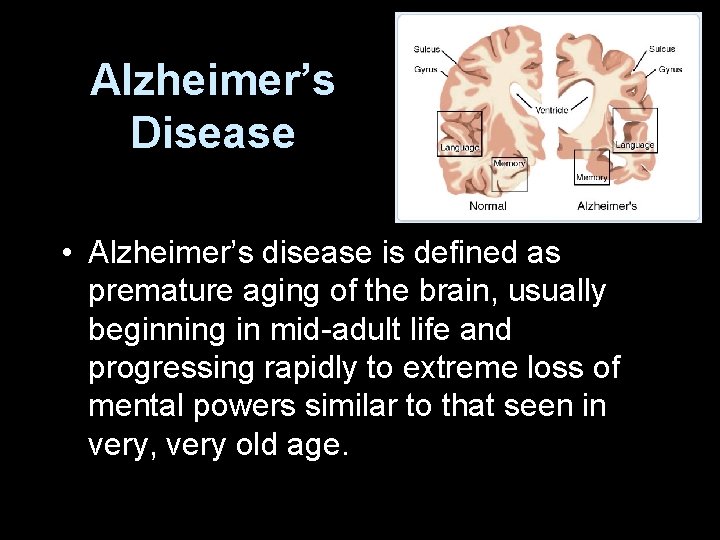 Alzheimer’s Disease • Alzheimer’s disease is defined as premature aging of the brain, usually