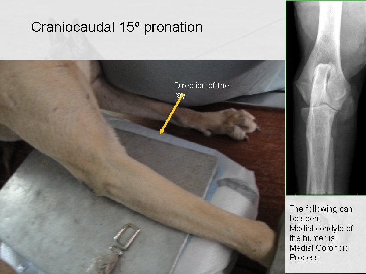 Craniocaudal 15º pronation Direction of the ray The following can be seen: Medial condyle