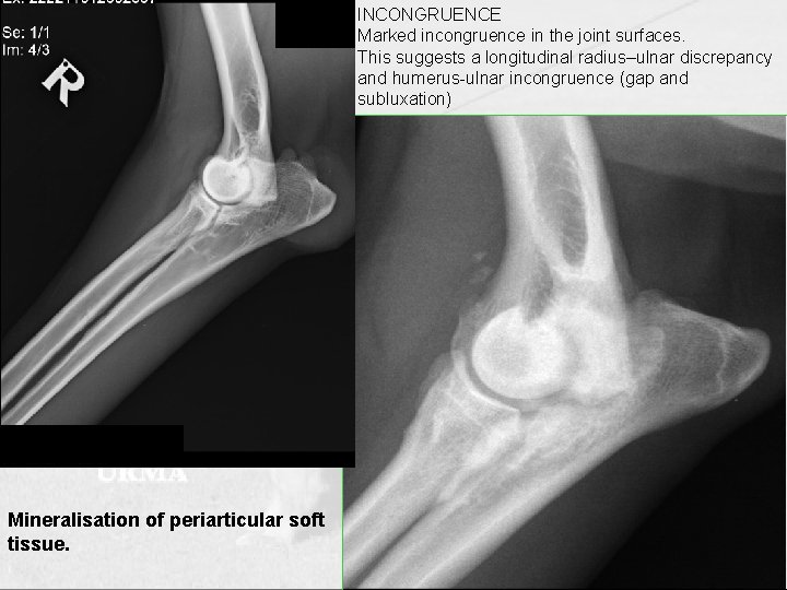 INCONGRUENCE Marked incongruence in the joint surfaces. This suggests a longitudinal radius–ulnar discrepancy and