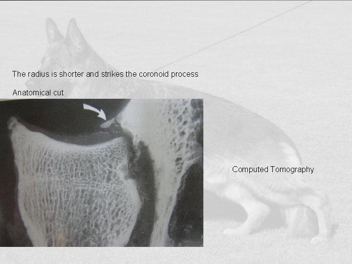 The radius is shorter and strikes the coronoid process Anatomical cut Computed Tomography 