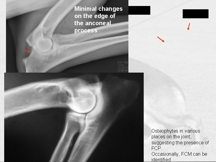 Minimal changes on the edge of the anconeal process Osteophytes in various places on