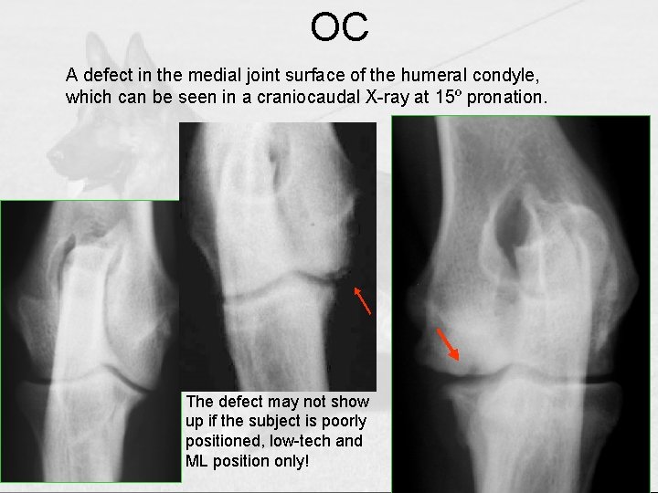 OC A defect in the medial joint surface of the humeral condyle, which can