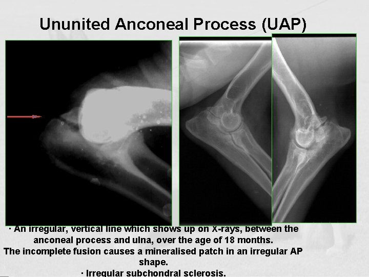 Ununited Anconeal Process (UAP) Growth line · An irregular, vertical line which shows up
