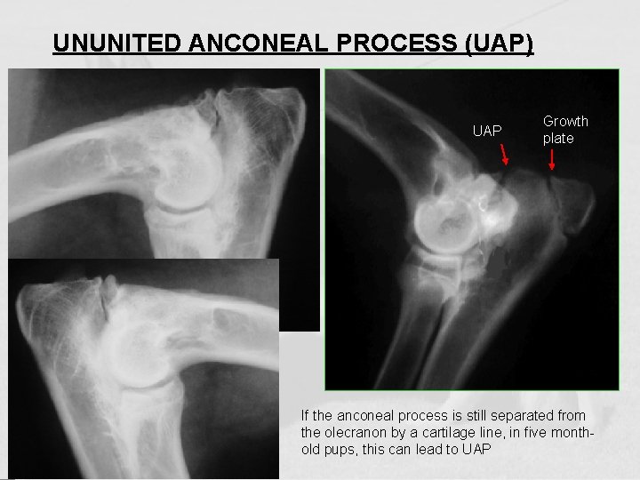 UNUNITED ANCONEAL PROCESS (UAP) UAP Growth plate If the anconeal process is still separated